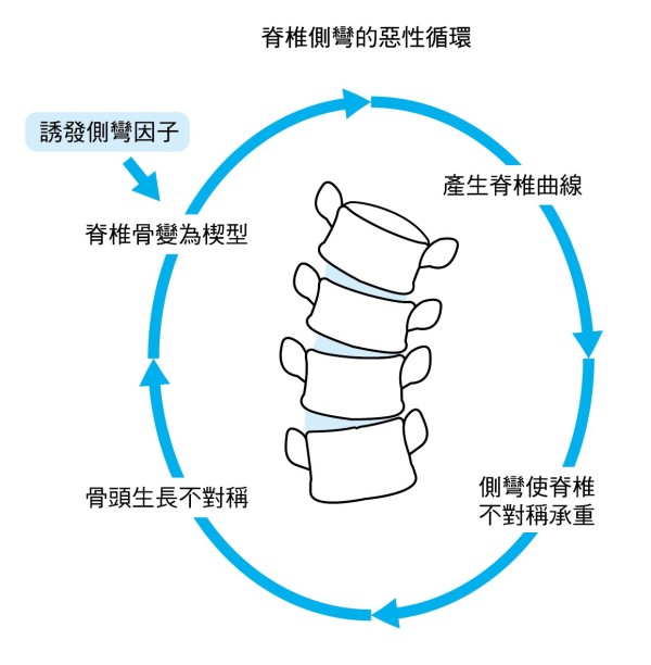 脊椎侧弯