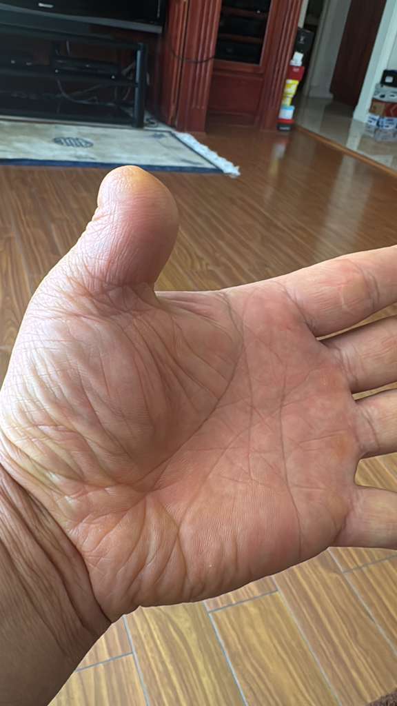 徐建超左手大拇指因中共迫害而被迫截斷一部分(徐建超提供)