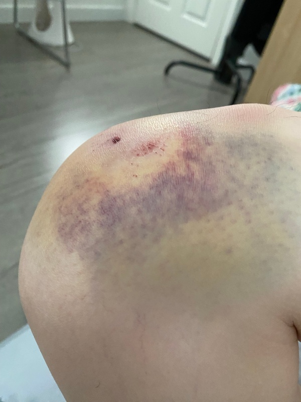 姜嘉偉遇襲受傷