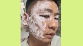 紙巾带毒安徽男子用紙巾擦汗後差點毀容(圖)