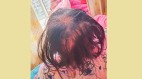 「鉈中毒」致大量脫髮湖南3歲女童驚傳被投毒(圖)
