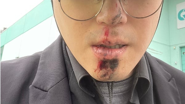 香港议会议长姜嘉伟遇袭受伤六四前夕的政治恐吓(组图)